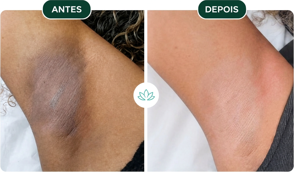 Antes e depois — resultado do Protocolo Axilas de Seda